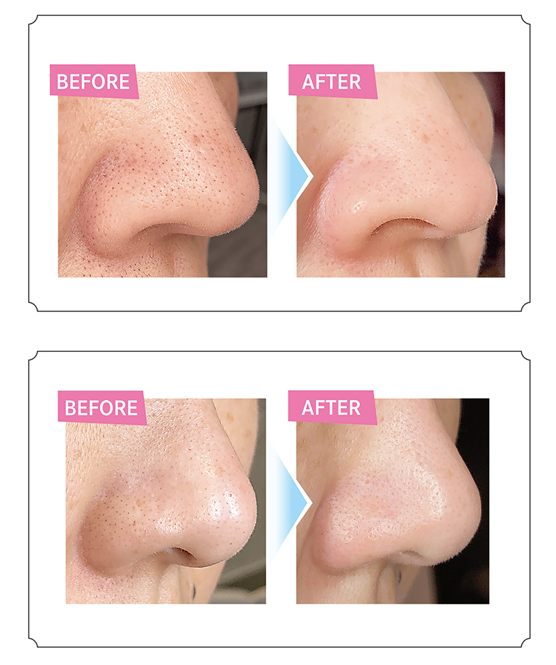 ハイドロスプラッシュ｜美肌改善サロン4C.