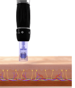 進化したダーマローラー A-MTS |クリニックブログ| ソララクリニック