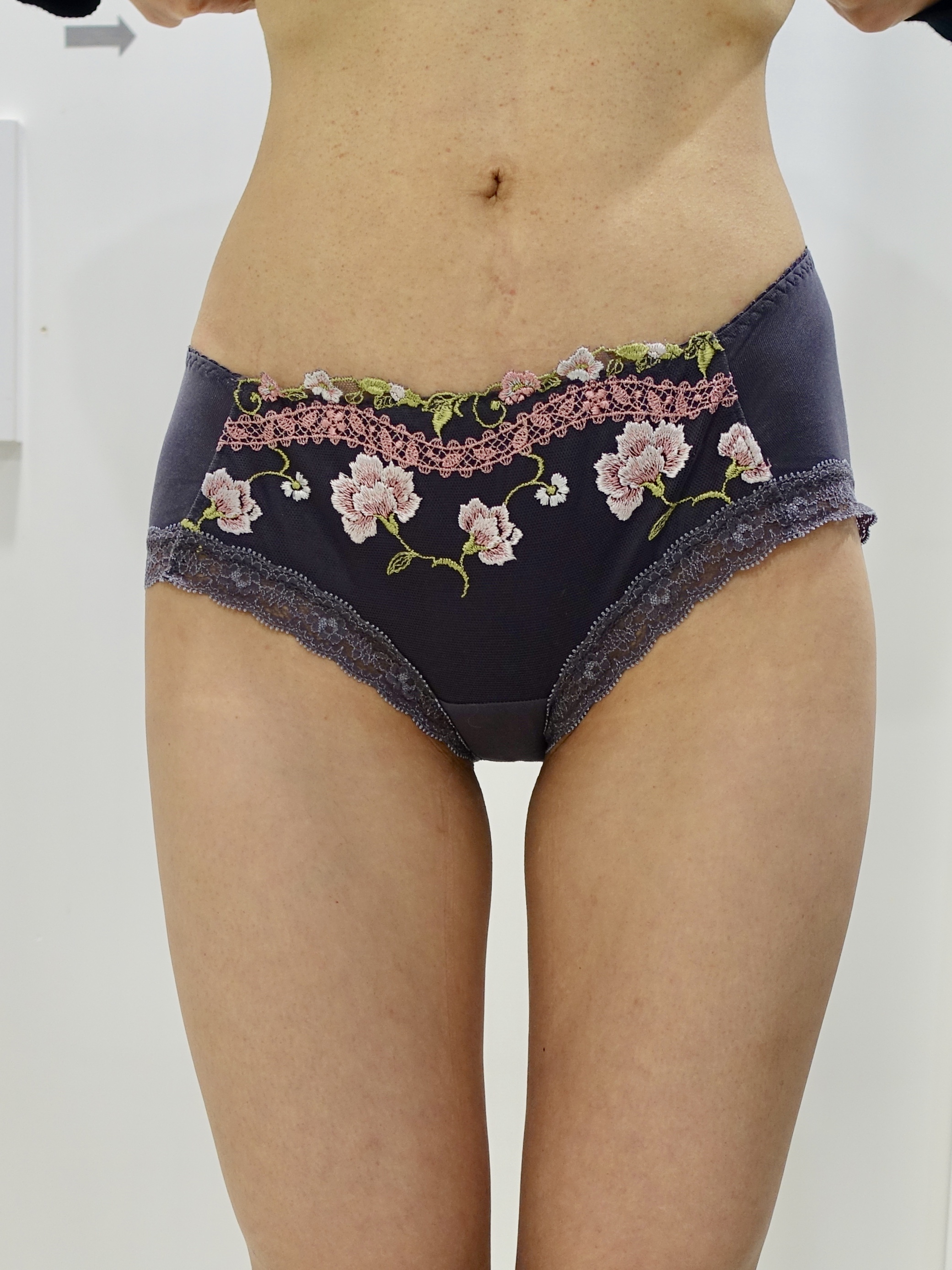 ライポソニックスでお腹とお尻が劇的スッキリ！ - 東京 渋谷 美容皮膚