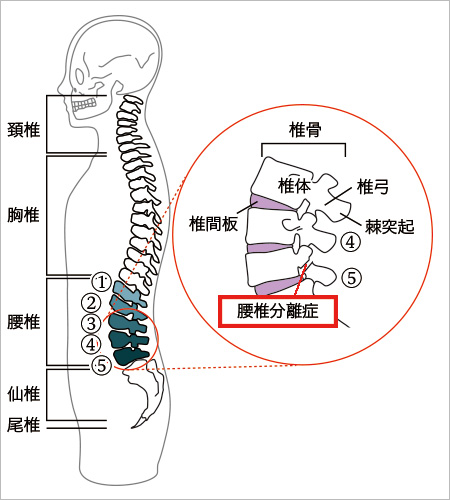 腰椎分離症 (ようついぶんりしょう)とは | 済生会