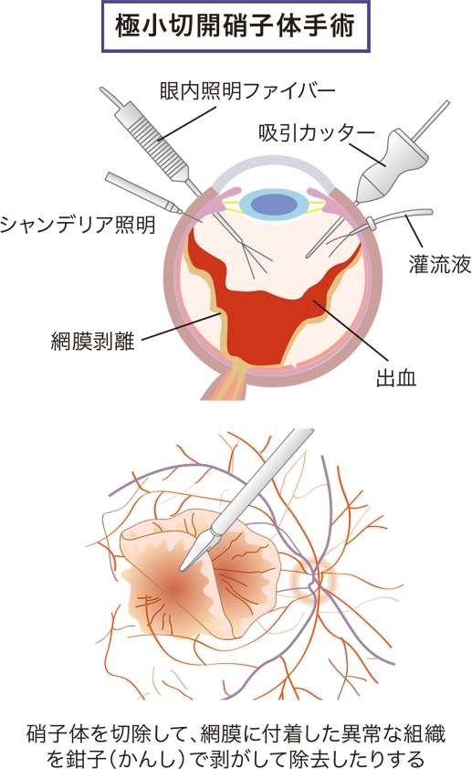 網膜硝子体手術について｜石羽澤先生(眼科)のコラム｜予防医学コラム