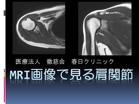 裁断済み】肩関節のMRI GH joint : 読影ポイントと新しい知見 肩関節の