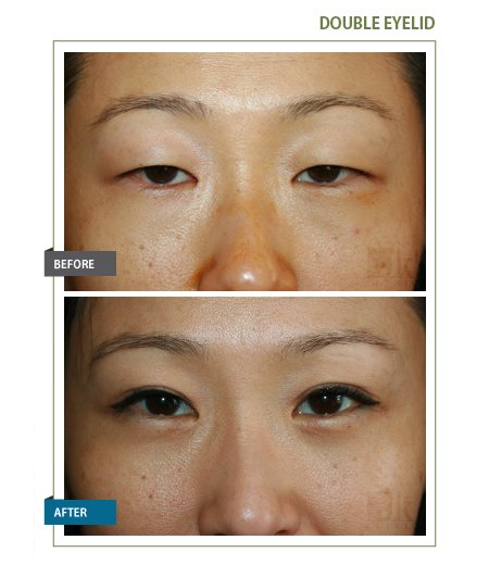 Asian Double Eyelid - John Kang MD F.A.C.S :: JK Facial Plastics