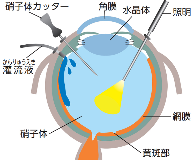最新の硝子体手術――より負担の少ない手術をめざして | 病気と治療の
