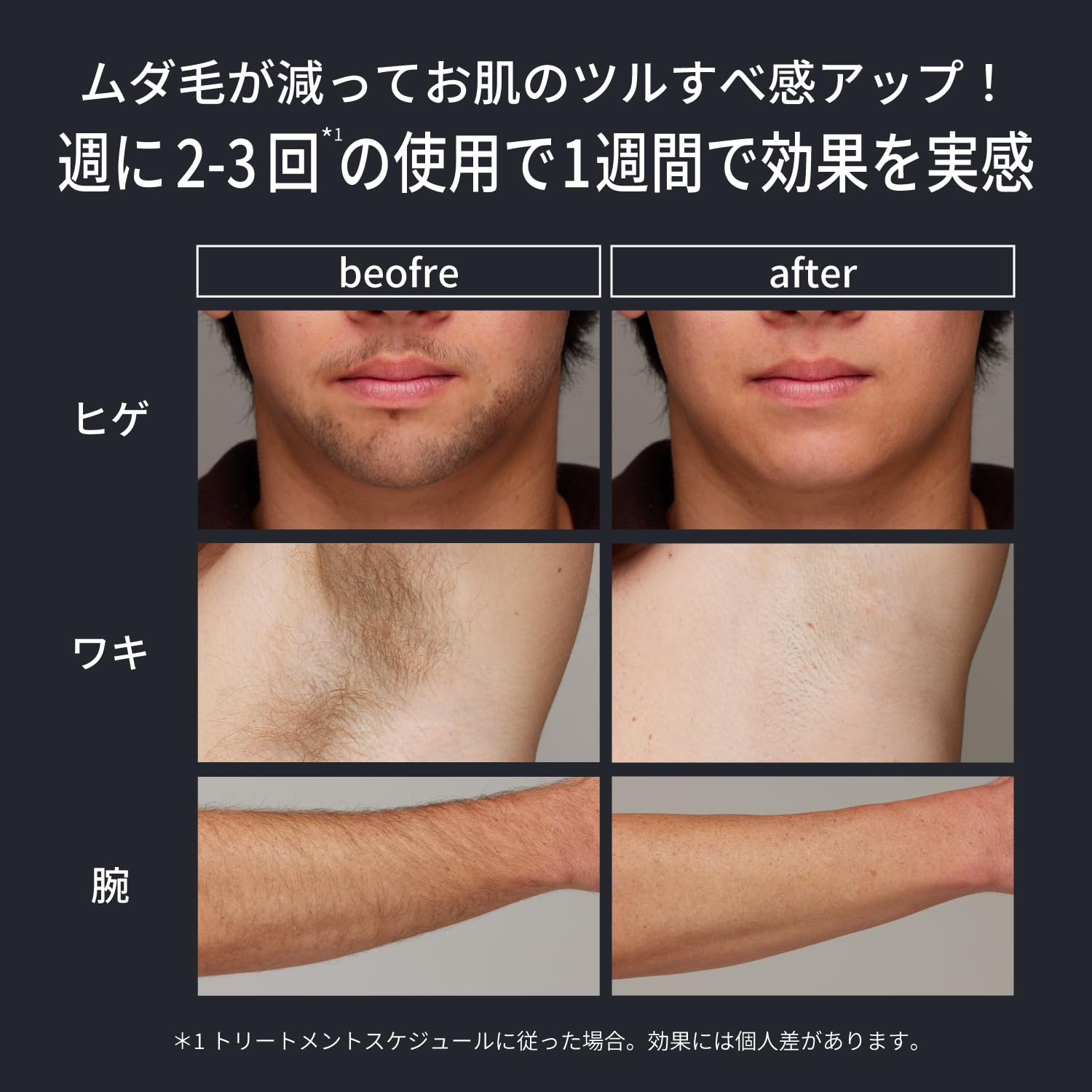 Amazon | 【2024年新モデル】Ulike Men 脱毛器 メンズ 髭 VIO対応 痛み