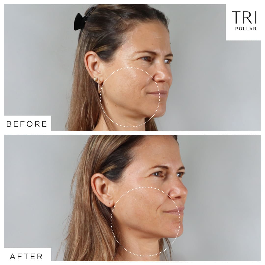 TriPollar STOP Vx GOLD – Luxury Jawline-Sculpting Anti-Aging Device