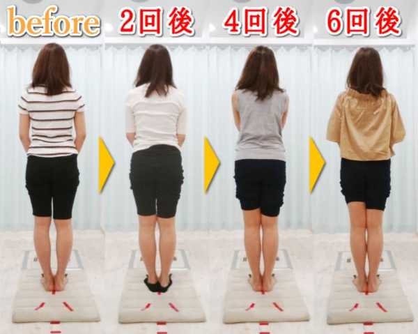 O脚矯正ビフォーアフター｜大阪のO脚矯正『整体院 そるん』