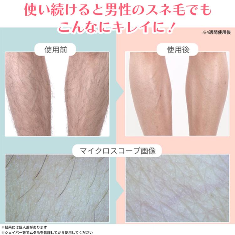 今 お得！】CQ クリニカルエピ プロフェッショナル／ムダ毛ケア／冷却