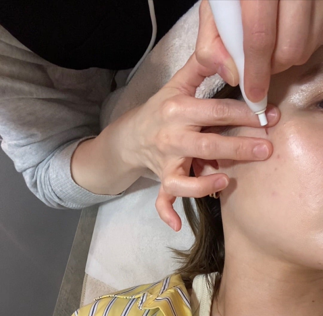 シミ取り》低周波ペンシルしてきました！ | Shiori's「on」style〜干物